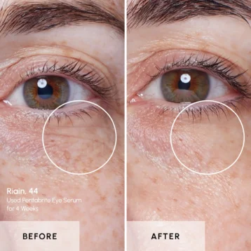 Pentabrite - Riains eye - Before and After